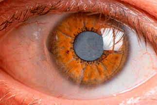 What is cataract and how can I treat it?