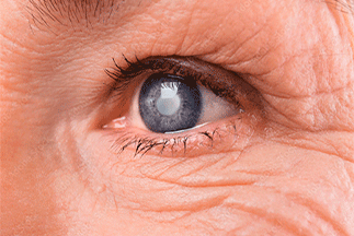 Glaucoma: the silent thief of sight